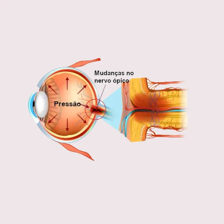 Cirurgia de Glaucoma​