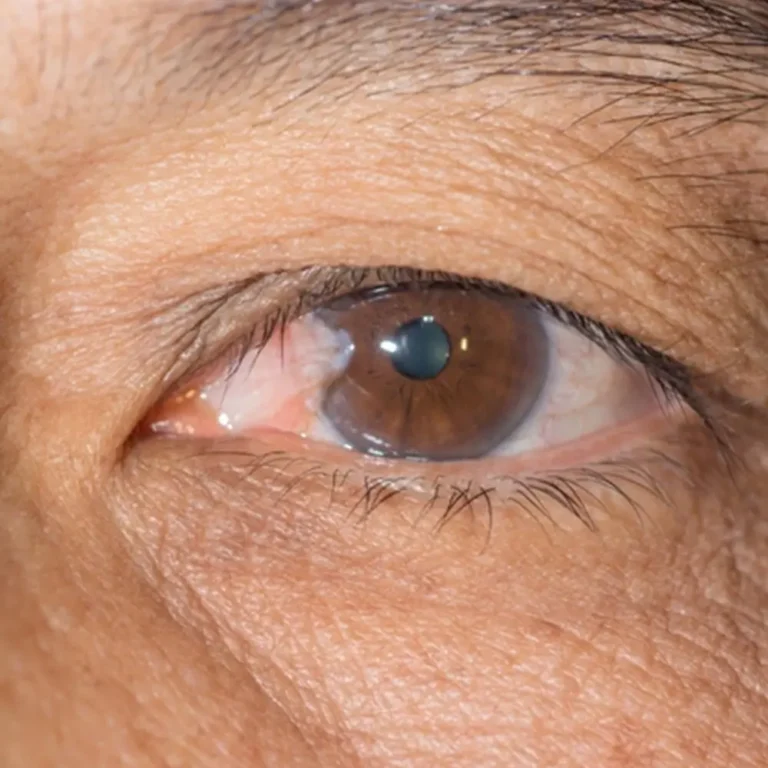 Cirurgia de Pterígio