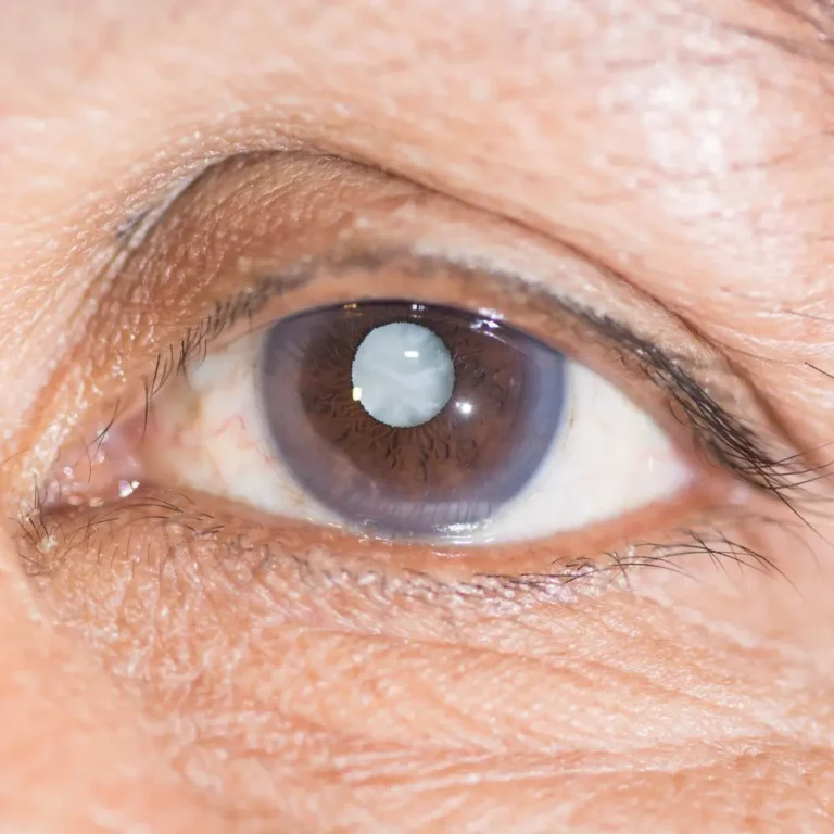 cirurgia de catarata